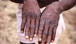 Understanding Mpox: Symptoms, Transmission, and Prevention